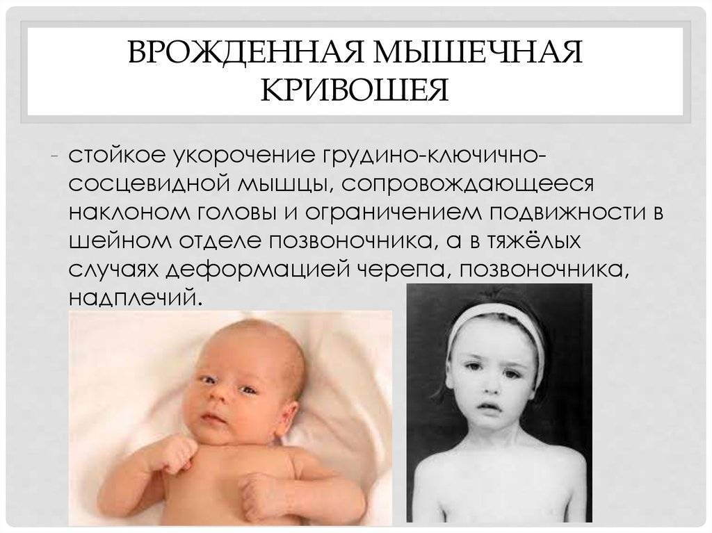 Массаж при кривошее: профилактика и лечение проблемы