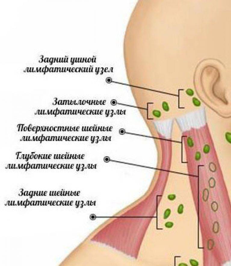 Увеличенные лимфоузлы на шее у ребенка: фото, причины, лечение