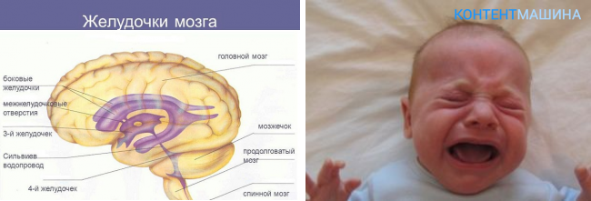 Мозг новорожденного норма. Желудочки в головном мозге у грудничков. Расширение боковых желудочков головного мозга у грудничка. Расширенные желудочки головного мозга у грудничка. Желудочки мозга расширены у новорожденного.