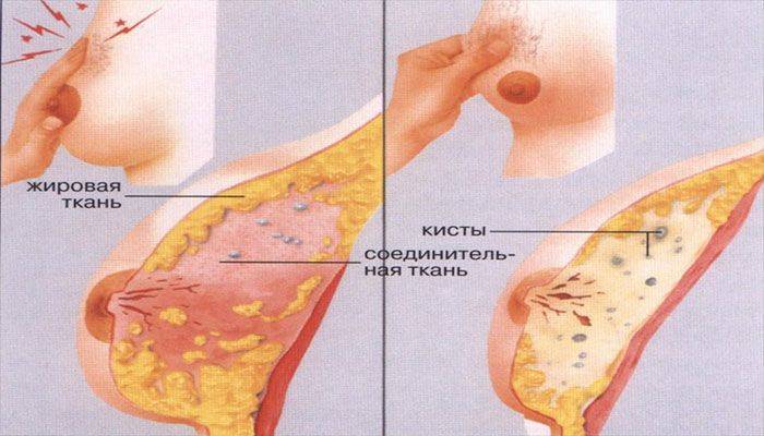 Причины боли в груди, масталгия | маммолог бондарь а.в