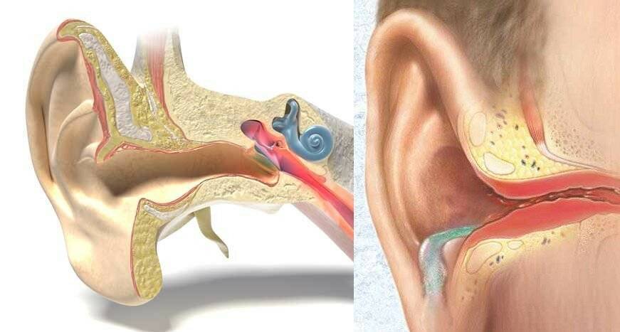 Причины воспаления среднего уха. Евстахиит барабанная перепонка. Хронический отит наружного уха.