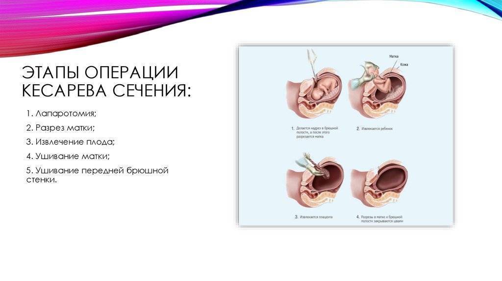 Кесарево сечение — плюсы и минусы. что делать после кесарева сечения — беременность. беременность по неделям.