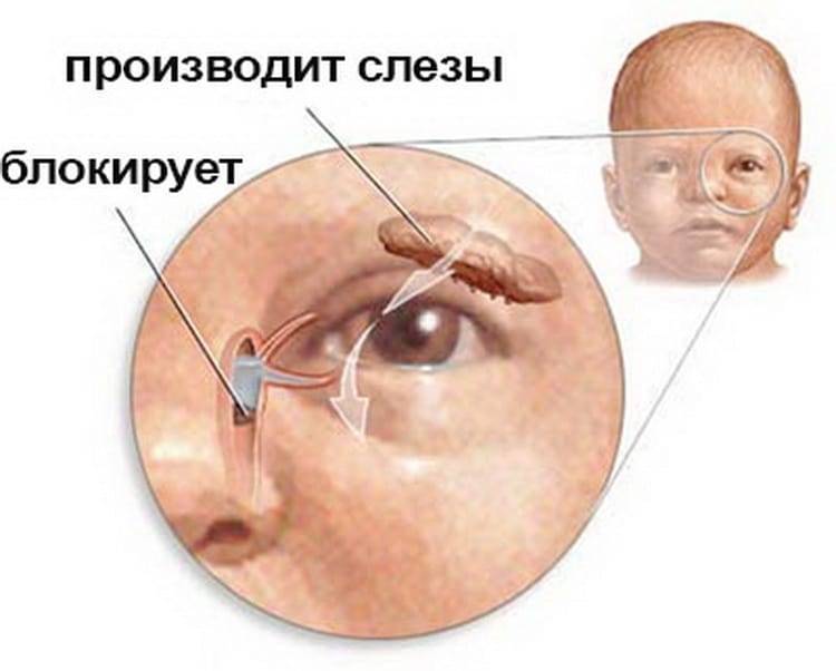 Закисает глазик у новорожденного - причины, лечение, последствия