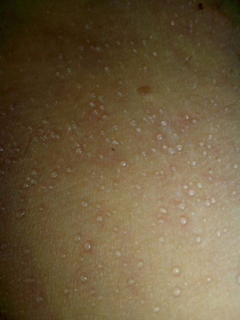 Бактериальные инфекции кожи: какие бывают, как лечить. правила профилактики
