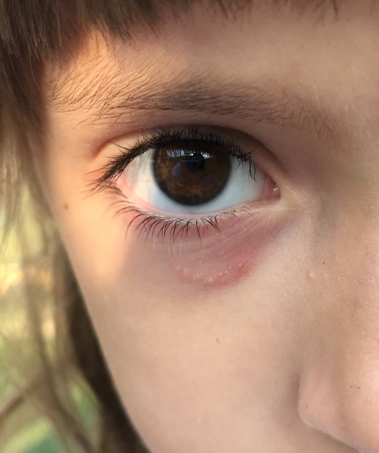Аллергия вокруг глаз  - симптомы, причины, профилактика и лечение