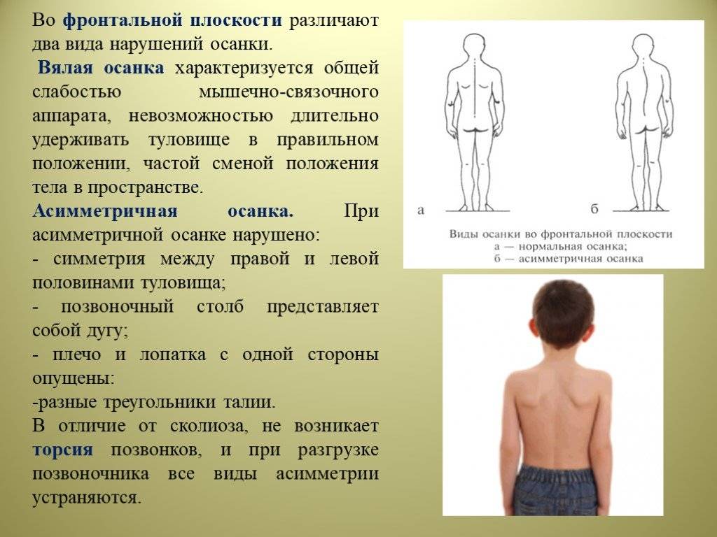 Сколиоз