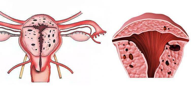 Структурные изменения матки. Эндометриоз аденомиоз матки. Аденомиоз и эндометриоз. Аденомиоз макропрепарат.