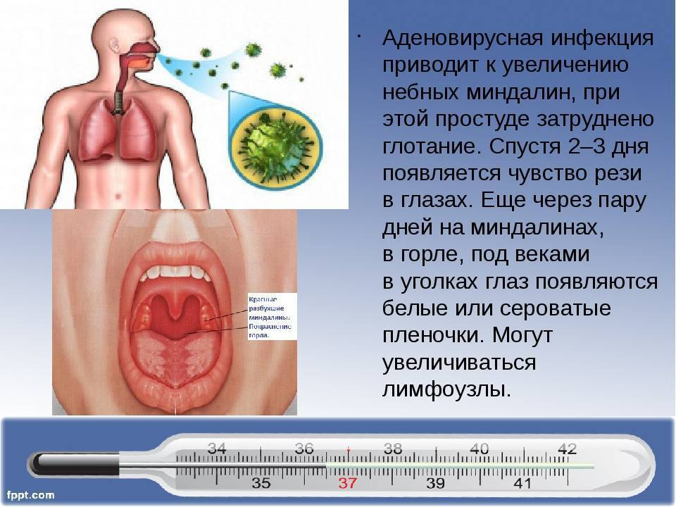 Аденовирусная инфекция — горклиника