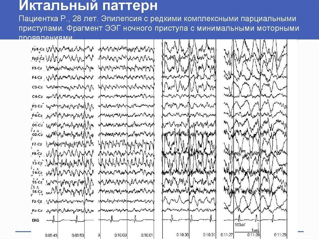 Ээг иркутск. Эпилептические паттерны на ЭЭГ. Альфа ритм ЭЭГ при эпилепсии. Расшифровка показателей электроэнцефалограммы ЭЭГ головного мозга. ЭЭГ при эпилепсии расшифровка.