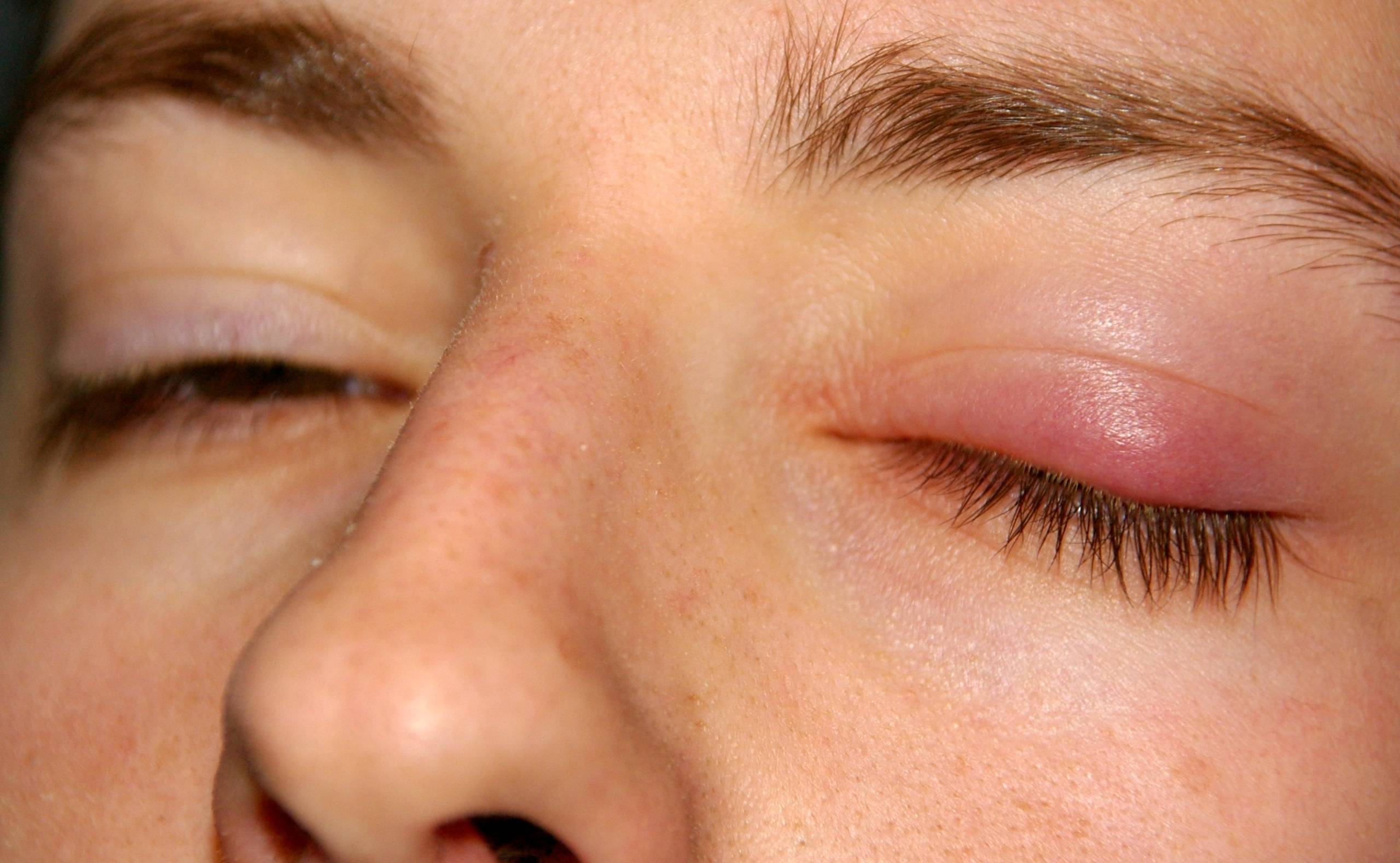 Шишка под глазом: причины и лечение шарика на нижнем веке под кожей