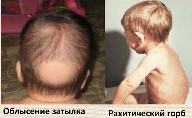 Признаки рахита у грудничков