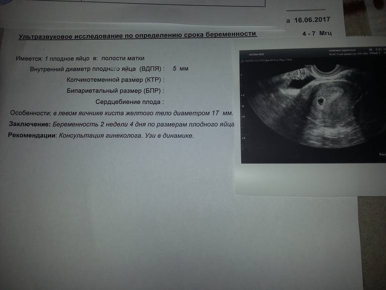 Причины и ранняя диагностика внематочной беременности