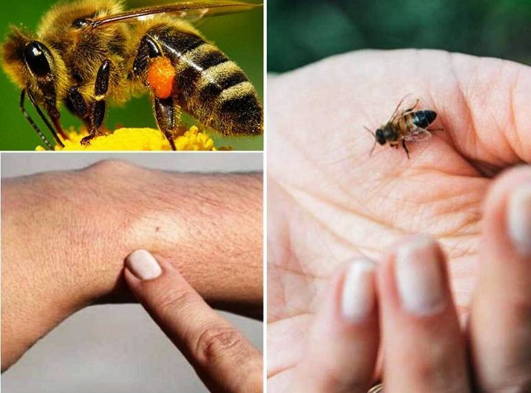 Что делать, при укусах осы или пчелы: первая помощь ребенку в домашних условиях