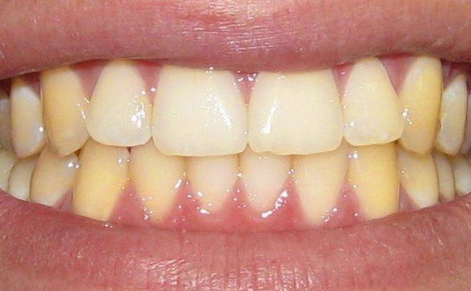 От стоматолога к гастроэнтерологу: налеты на зубах. - блог врача олега конобейцева