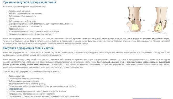 Вальгусная деформация стопы у детей | симптомы | диагностика | лечение - docdoc.ru
