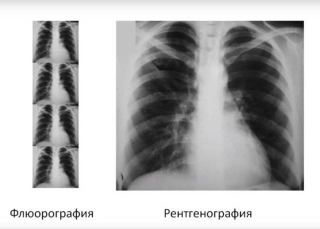 Что такое рентген при. Флюорография и рентгенография грудной клетки разница. Рентген органов грудной клетки и флюорография разница. Рентгенография рентгеноскопия флюорография. Флюорография и рентген грудной клетки разница.
