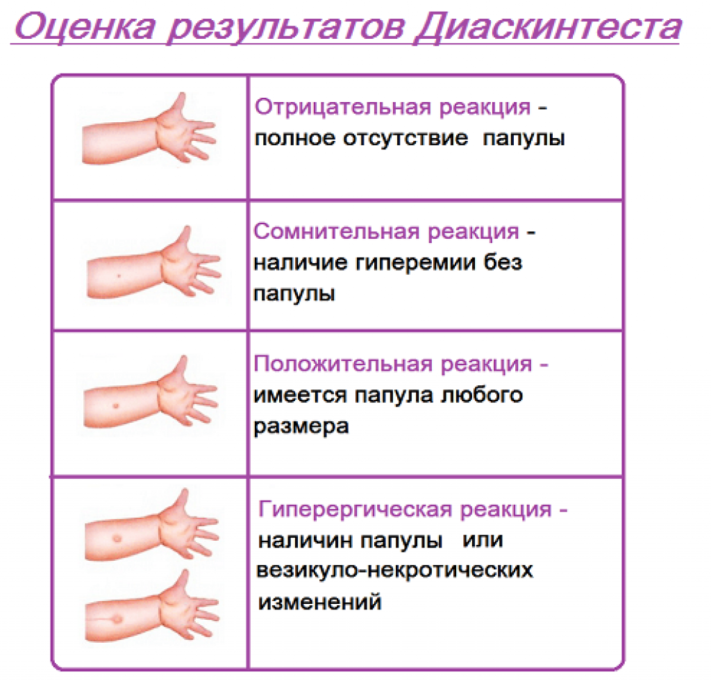 Положительная оценка. Отрицательный диаскинтест папула 10мм. Проба диаскинтест оценка результатов. Папула реакция диаскинтест. Диаскинтест оценка результатов через.