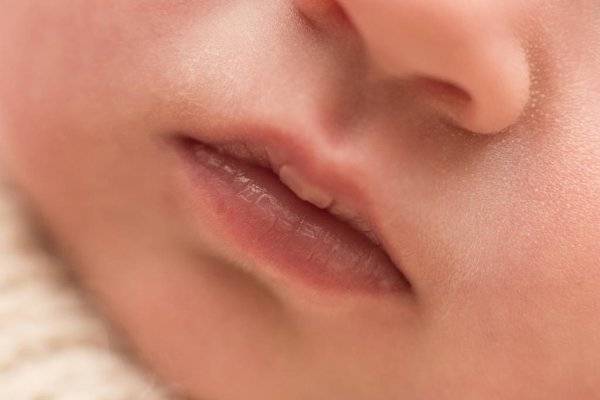 Мозоль на губе у новорожденного при грудном вскармливании