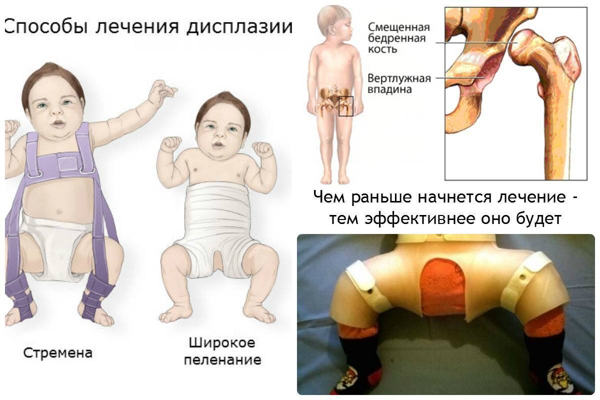 Что такое тбс. Врождённая дисплазия ТБС. Дисплазия тазобедренных суставов 3ст. 2х сторонняя дисплазия тазобедренных суставов. Врождённый вывих бедра дисплазия.