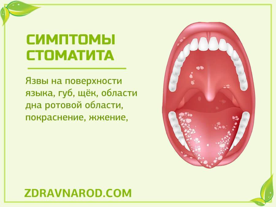 Воспаление под языком: причины, симптомы, лечение, профилактика