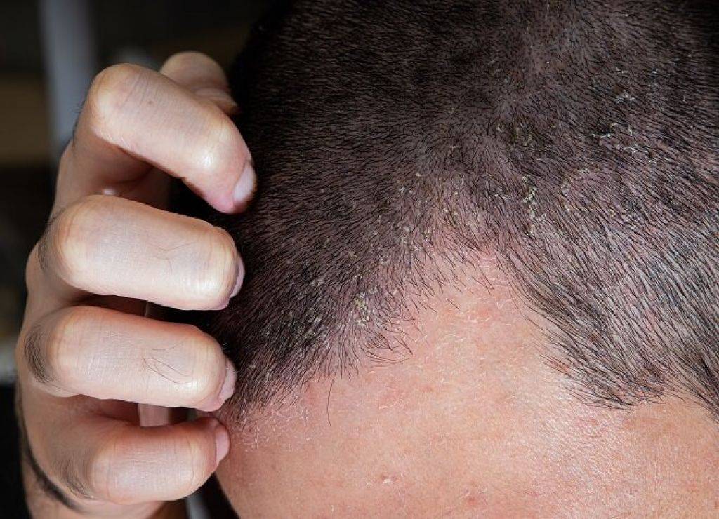 Себорея кожи головы у взрослых и детей: причины и лечение