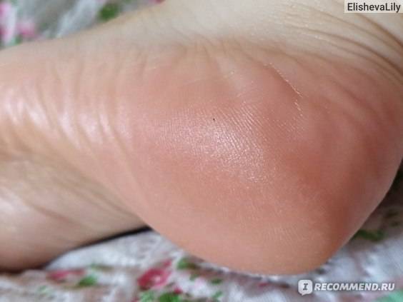 У ребенка облазит кожа на пальцах ног и ступнях: почему шелушатся пятки, стопы, и слезает кожа