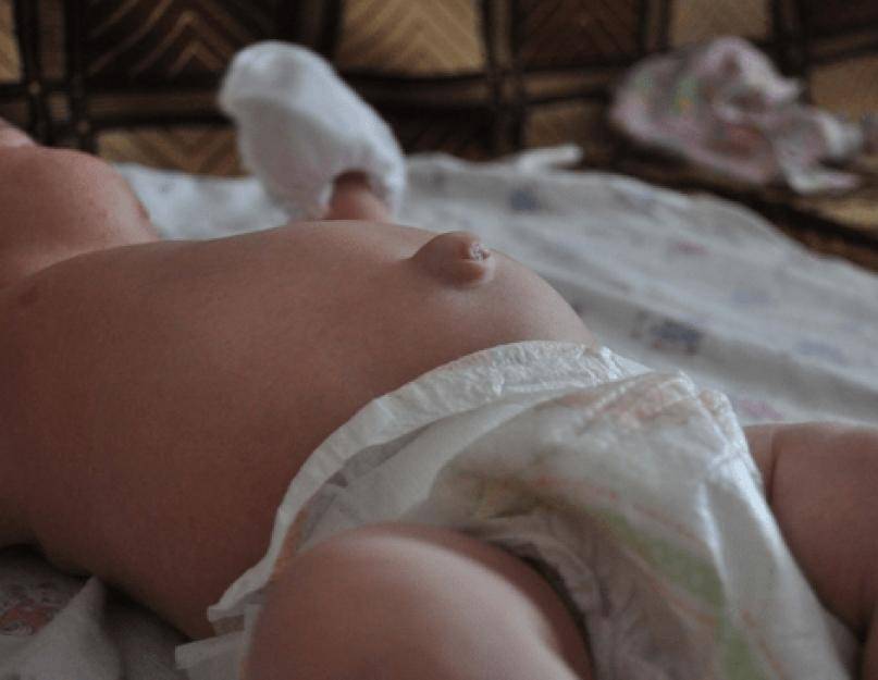 Кровит пупок у новорожденного: что делать, почему, сколько может кровить