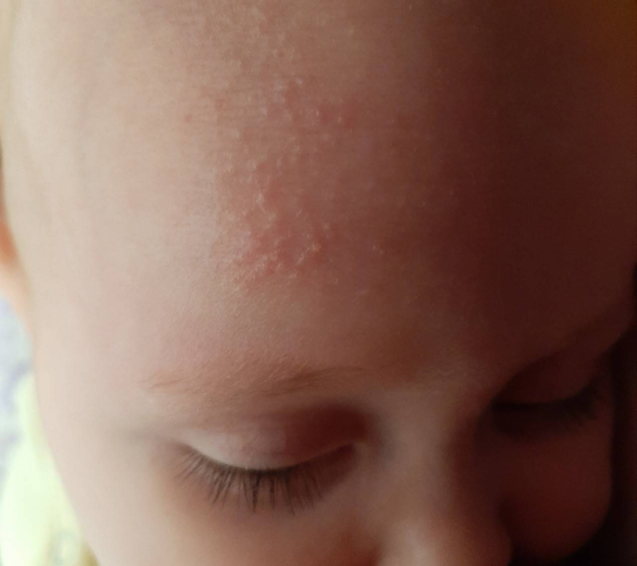 Аллергия как укус комара от чего: симптомы, лечение, профилактика | детская поликлиника химки