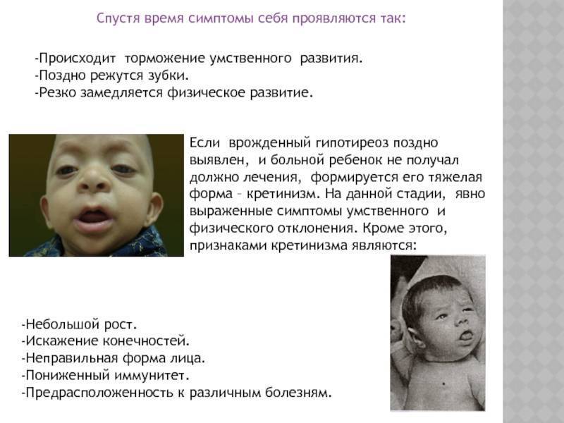 Клиническая картина гипотиреоза у детей