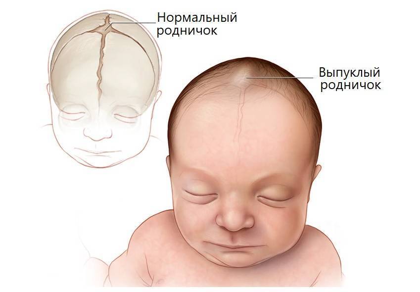 Родничок у новорожденных: когда закрывается, отклонения от нормы, рекомендации врачей — моироды.ру