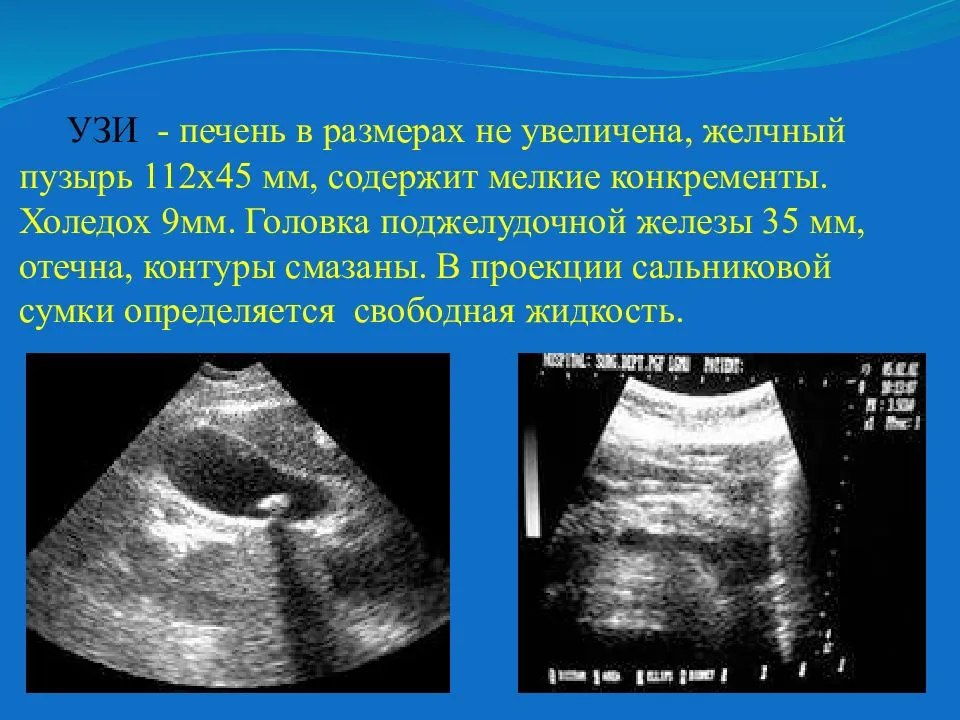 Увеличение печени. симптомы и лечение гепатомегалии печени.