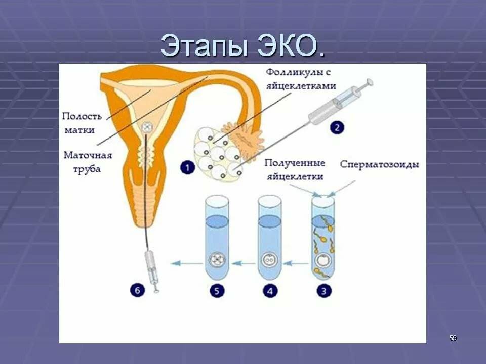 Экстракорпоральное оплодотворение - эко
