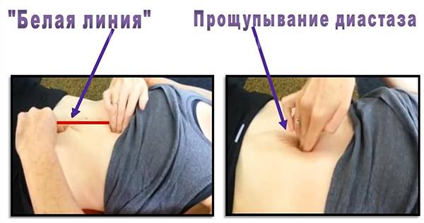 Диастаз после родов - как определить, как убрать самостоятельно?