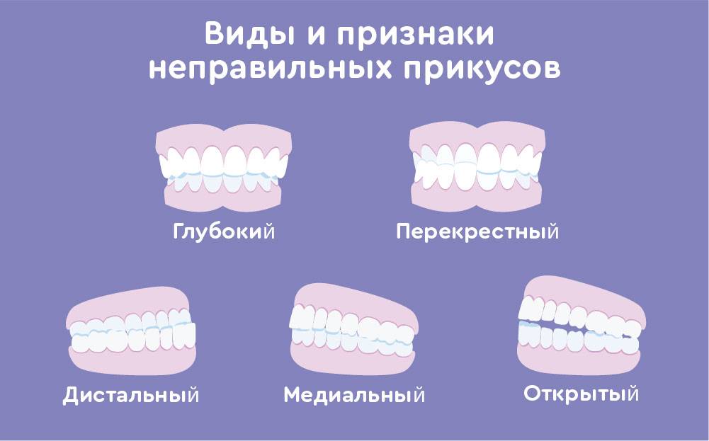 У ребенка неправильный прикус - что делать, как исправить