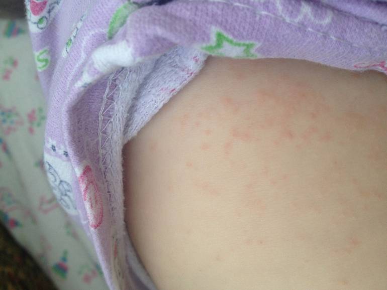 Аллергия на памперсы: фото, симптомы и лечение у детей