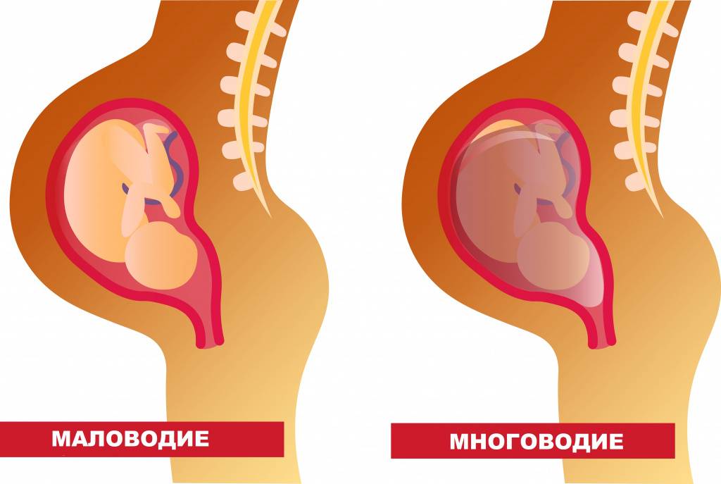 Лечение маловодия при беременности, чем опасно данное состояние? / mama66.ru
