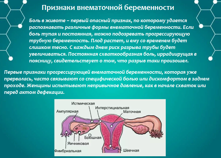 Внематочная беременность
