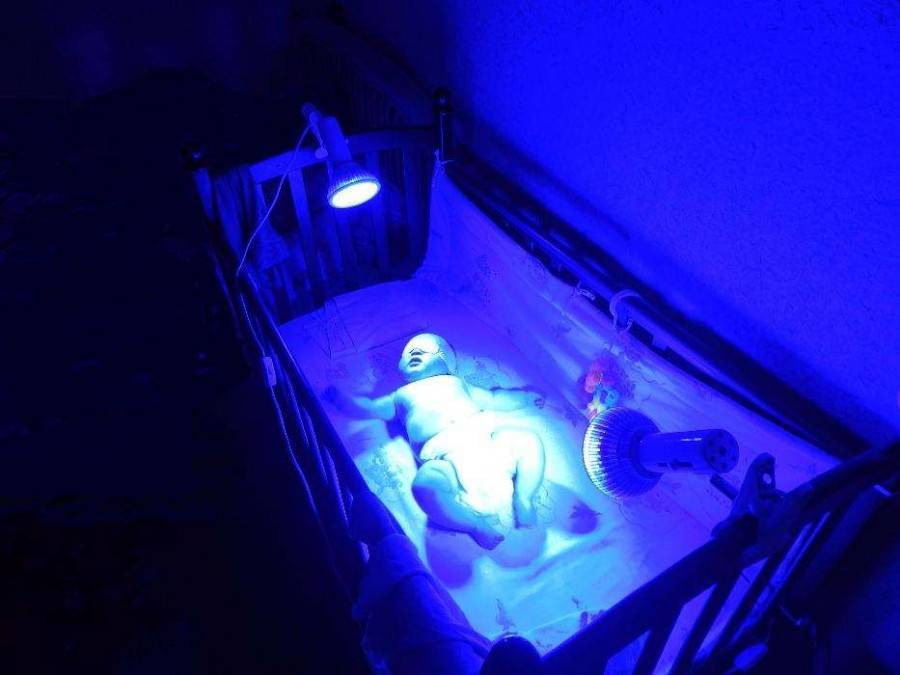 Лечение желтухи новорожденного в домашних условиях
