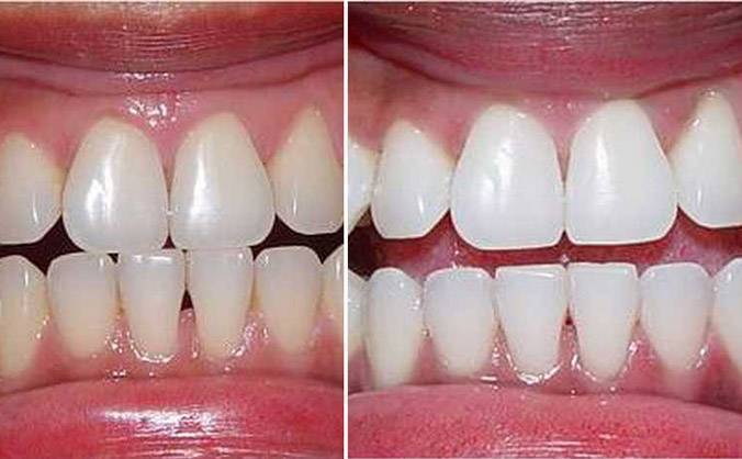 отбеливание зубов покрытие эмали