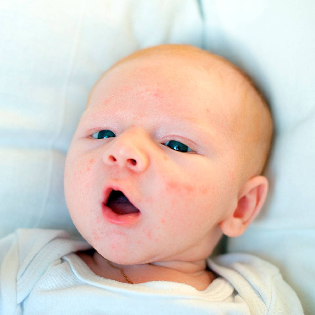 Гормональная сыпь у новорожденных и грудничков: признаки и лечение