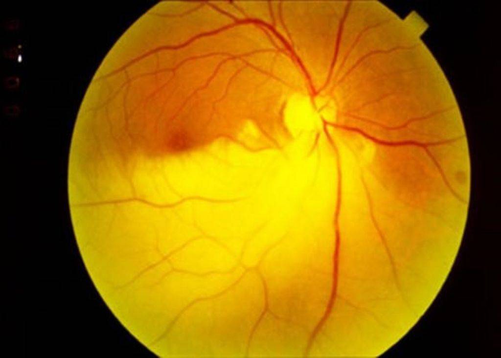 Ангиопатия сетчатки глаза у ребенка и ее лечение