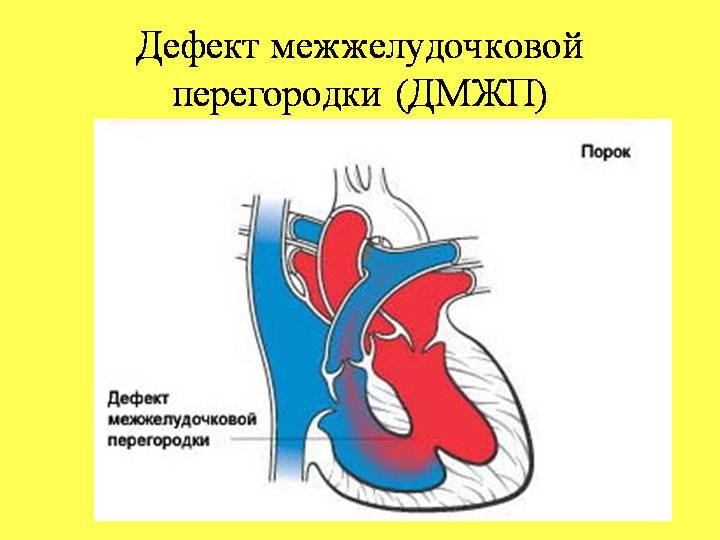 Гемодинамика дмжп у детей схема