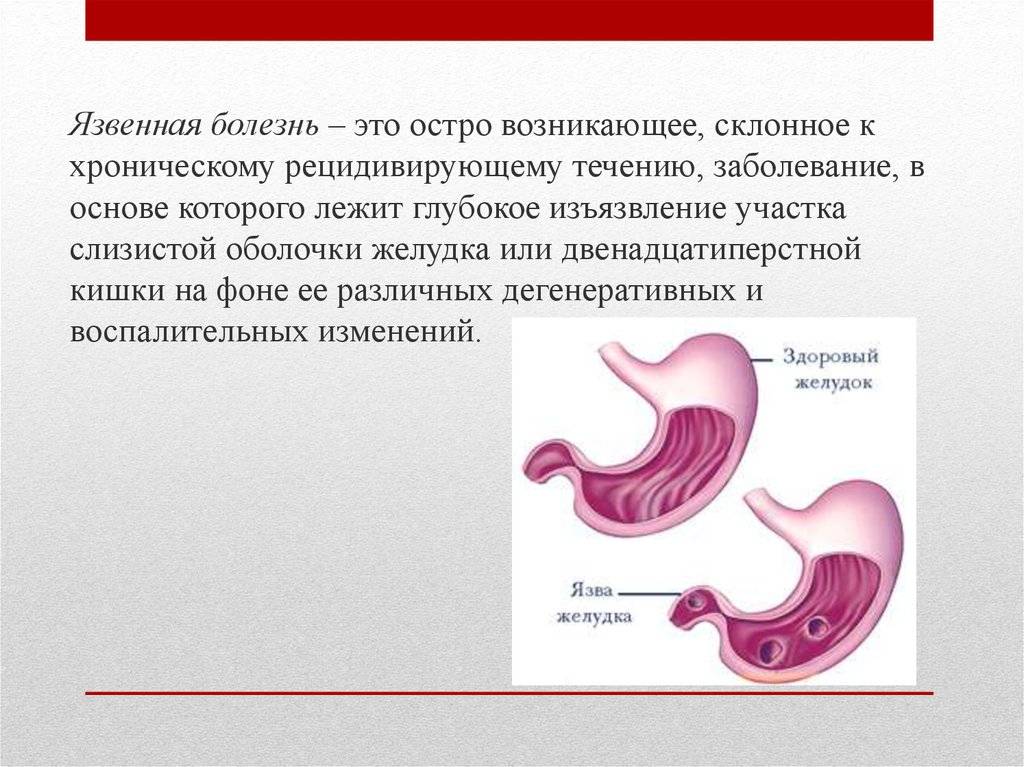 Язвенная болезнь двенадцатиперстной кишки картинки