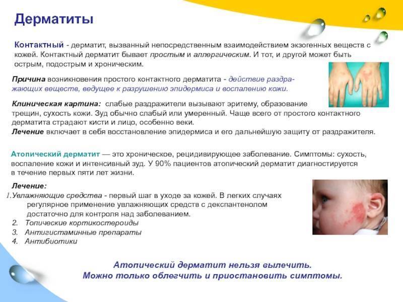 Атопический дерматит у детей: фото, лечение, симптомы в начальной стадии