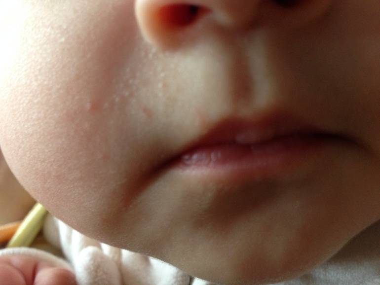 Мозоль на губе у новорожденного ребенка: причины. когда стоит беспокоиться - onwomen.ru