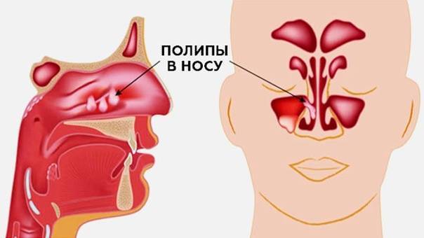 Полипоз носа: причины, проявления, методы лечения полипов в носу