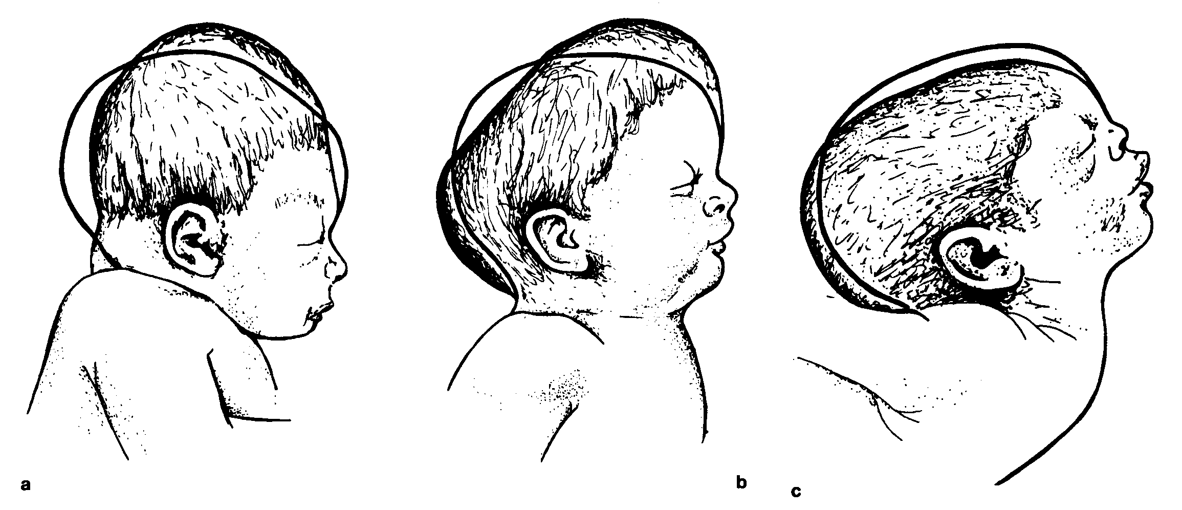 Уменьшение окружности головы (микрокрания) у ребенка: причины, диагностика, лечение