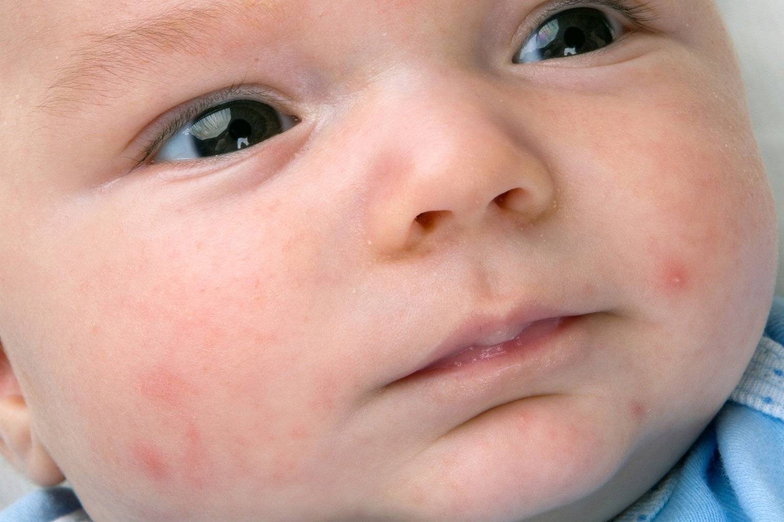 Пищевая аллергия: причины, формы и типичные проявления