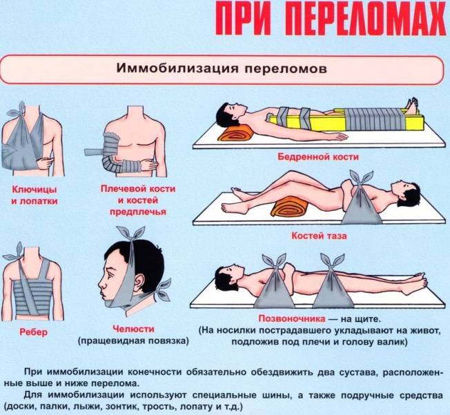 Как оказать первую помощь при переломе - wikihow