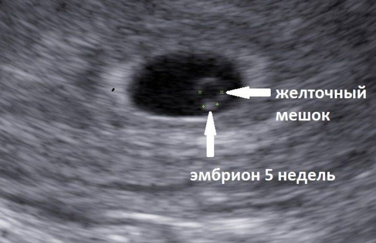 Беременна или нет? узи покажет, куда делся эмбрион
